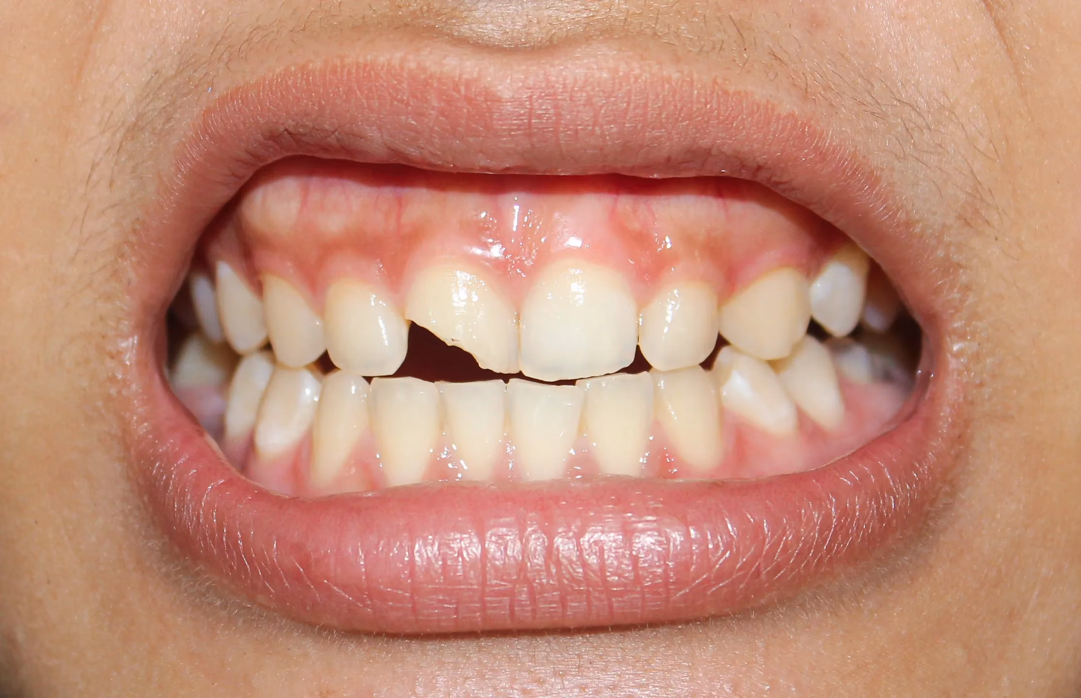 Cracked Tooth Repair