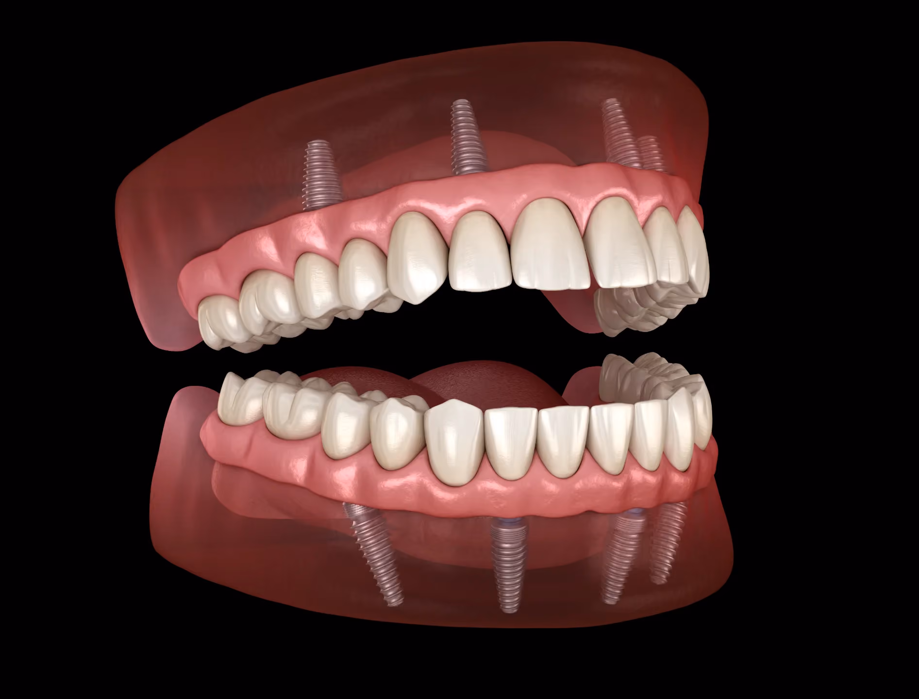 All-on-4 Implant Restorations